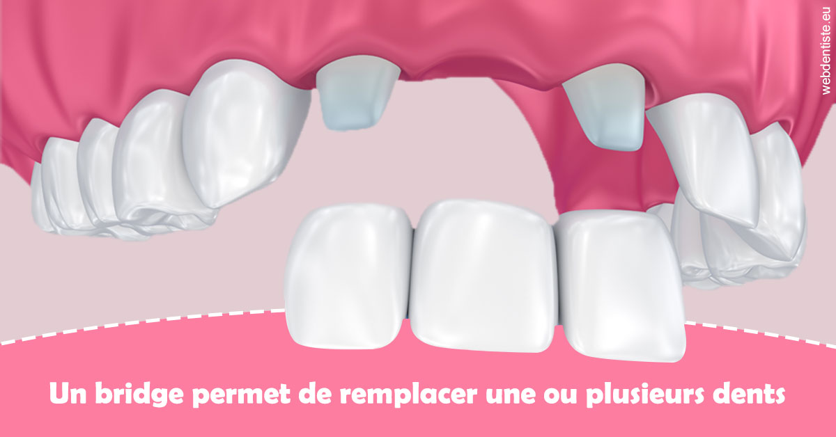 https://dr-laquille-sophie.chirurgiens-dentistes.fr/Bridge remplacer dents 2