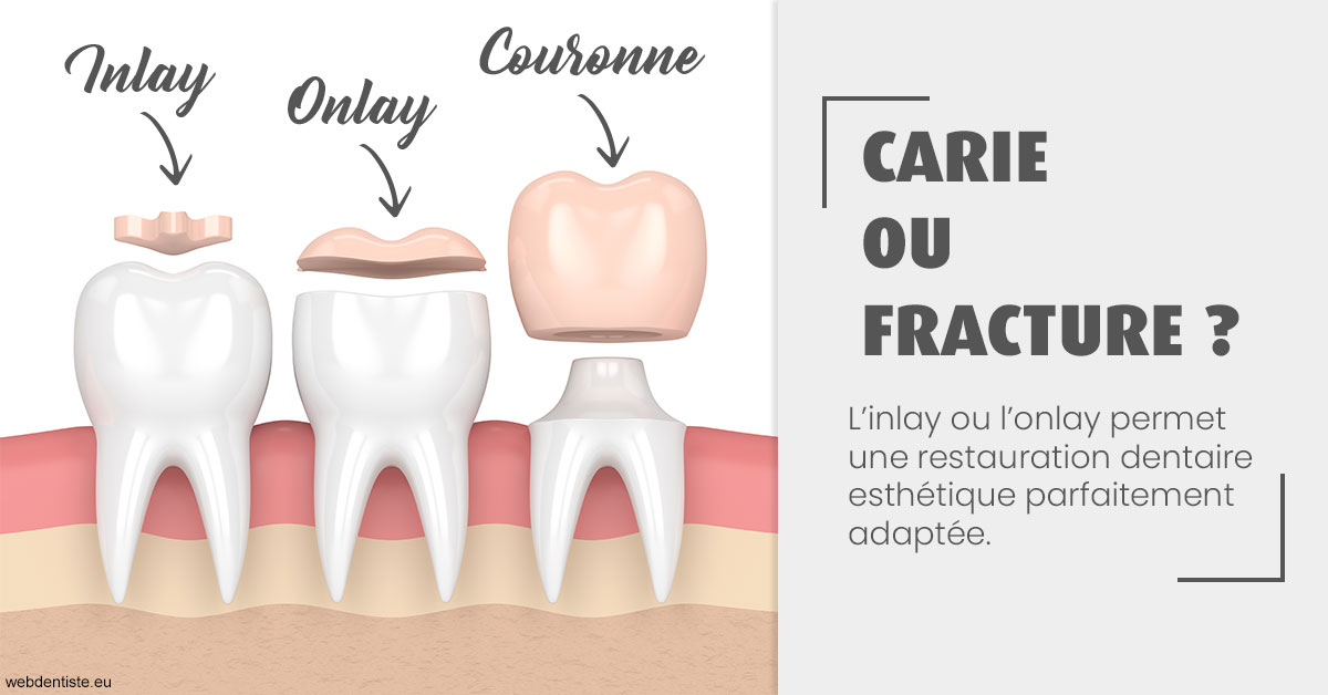 https://dr-laquille-sophie.chirurgiens-dentistes.fr/T2 2023 - Carie ou fracture 1