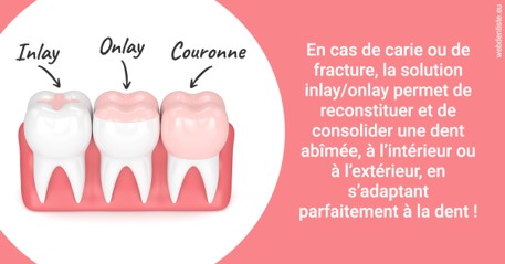 https://dr-laquille-sophie.chirurgiens-dentistes.fr/L'INLAY ou l'ONLAY 2