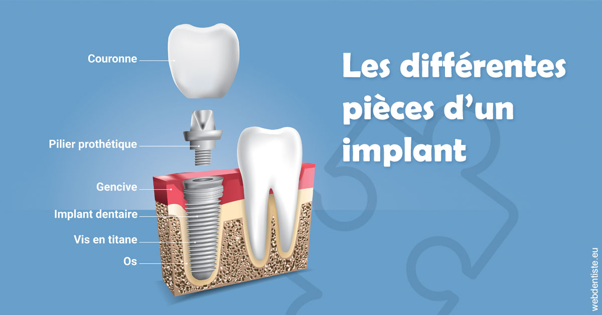 https://dr-laquille-sophie.chirurgiens-dentistes.fr/Les différentes pièces d’un implant 1